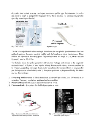 Spinal cord Stimulation | PDF