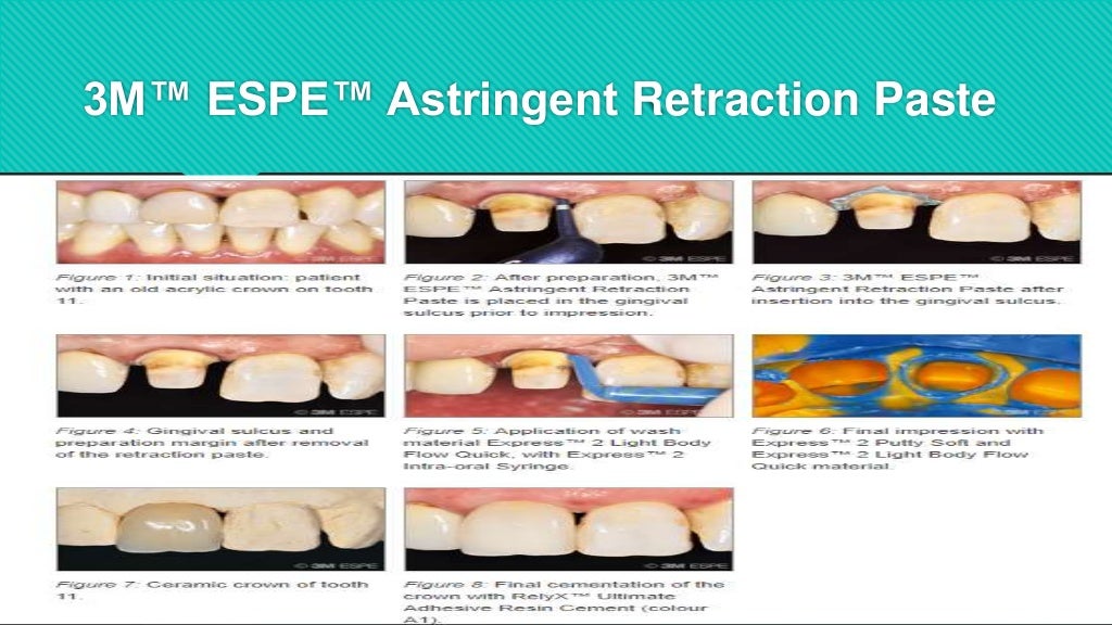 Gingival Retraction
