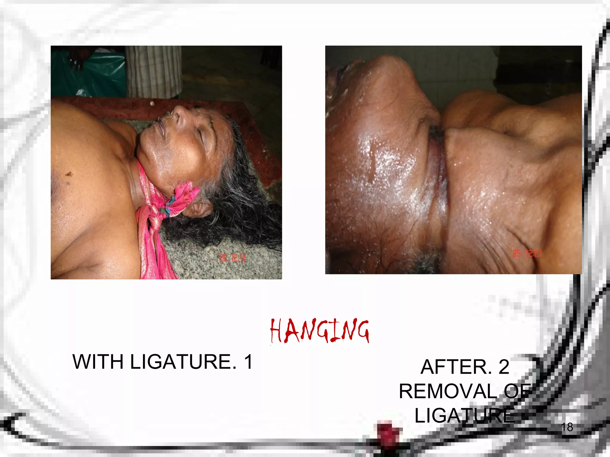 HANGING 
WITH LIGATURE. 1 AFTER . 2 
REMOVAL OF 
LIGATURE 18 
 