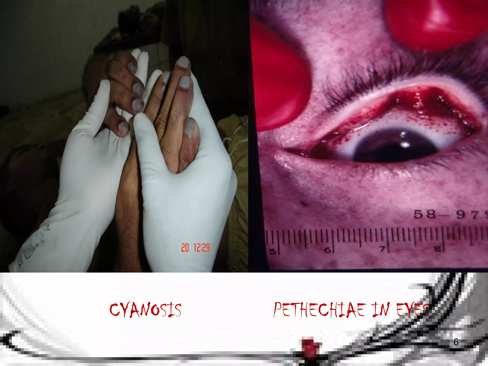 PETHECHIAE IN EYES 
6 
CYANOSIS 
 