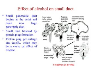 Effect of alcohol on small duct 
• Small pancreatic duct 
begins at the acini and 
drain into large 
pancreatic duct 
• Small duct blocked by 
protein plug formation 
• Protein plug get enlarge 
and calcify, which may 
be a cause or effect of 
disease 
Freedman at al 1993 
 