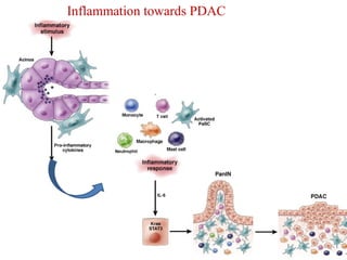 Inflammation towards PDAC 
 