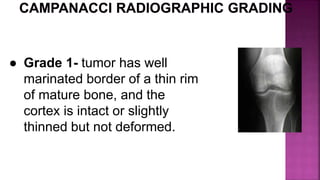 ● Grade 1- tumor has well
marinated border of a thin rim
of mature bone, and the
cortex is intact or slightly
thinned but not deformed.
 