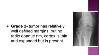 ● Grade 2- tumor has relatively
well defined margins, but no
radio opaque rim, cortex is thin
and expanded but is present.
 