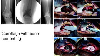 Curettage with bone
cementing
 