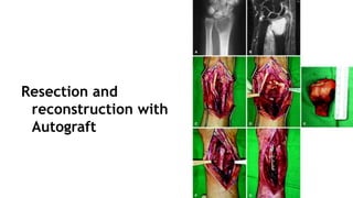 Resection and
reconstruction with
Autograft
 