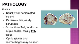 Gross:
● Usually well demarcated
lesions.
● Capsule – thin, easily
disruptable
● Cut section- Soft, reddish –
purple, friable, focally fritty
tissue.
● Cystic spaces and
haemorrhages may be seen.
 