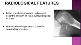 ● lesion is well circumscribed, radiolucent,
eccentric and with an intact surrounding shell
of bone .
● centrally there is lytic area >2cm with
surrounding sclerosis.
 