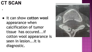 .
● it can show cotton wool
appearance when
calcification of tumor
tissue has occured...if
cotton wool appearance is
seen in lesion...it is
diagnostic.
 