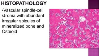 •Vascular spindle-cell
stroma with abundant
irregular spicules of
mineralized bone and
Osteoid
 