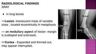 RADIOLOGICAL FINDINGS
XRAY
● in long bones
>>Lesion -translucent mass of variable
sizes , located eccentrically in metaphysis
>> on medullary aspect of lesion- margin
is scalloped and sclerosed.
>>Cortex - Expanded and thinned out,
may appear interrupted.
 