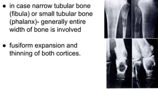 ● in case narrow tubular bone
(fibula) or small tubular bone
(phalanx)- generally entire
width of bone is involved
● fusiform expansion and
thinning of both cortices.
 