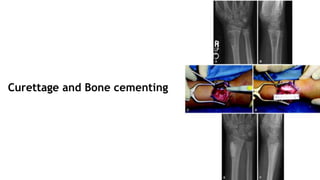 Curettage and Bone cementing
 