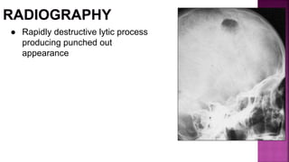 ● Rapidly destructive lytic process
producing punched out
appearance
 
