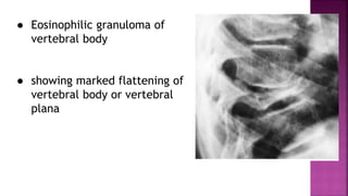 ● Eosinophilic granuloma of
vertebral body
● showing marked flattening of
vertebral body or vertebral
plana
 