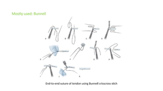 Comprehensive Overview of Common Flexor and Extensor Tendon Injuries of ...
