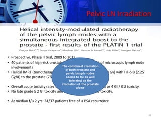 Pelvic LN Irradiation
• Prospective, Phase II trial, 2009 to 2012,
• 40 patients of high-risk prostate cancer (increased risk of microscopic lymph node
involvement)
• Helical IMRT (tomotherapy) of the pelvic lymph nodes (51.0 Gy) with HF-SIB (2.25
Gy/#) to the prostate (76.5 Gy) in 34 fractions
• Overall acute toxicity rates were low and no acute grade 3 or 4 GI / GU toxicity.
• No late grade ≥ 2 GI toxicity and 6.4 % late grade 2 GU toxicity.
• At median f/u 2 yrs: 34/37 patients free of a PSA recurrence
49
The combined irradiation
of both prostate and
pelvic lymph nodes
seems to be as well
tolerated as the
irradiation of the prostate
alone
 