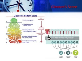 Gleason’s Score
 