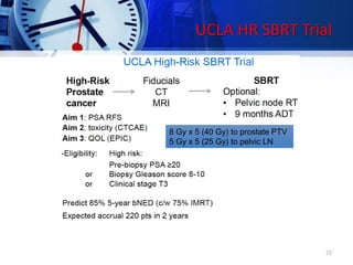 UCLA HR SBRT Trial
8 Gy x 5 (40 Gy) to prostate PTV
5 Gy x 5 (25 Gy) to pelvic LN
72
 