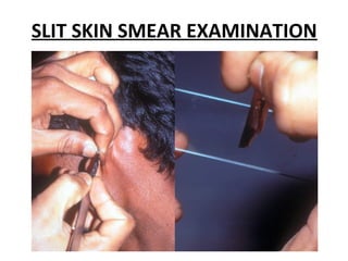 Slit Def Common Laboratory investigations in dermatology | PPT