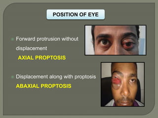 POSITION OF EYE
 Forward protrusion without
displacement
AXIAL PROPTOSIS
 Displacement along with proptosis
ABAXIAL PROPTOSIS
 