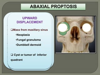 AXIAL PROPTOSIS
Lesions of intraconal space
Optic nerve glioma
Optic nerve sheath meningioma
Cvernous hemangioma, Orbital
varix
Schwannoma
Neurofibroma
Cystic lesion
Thyroid associated orbitopathy
 Idiopathic orbital inflammation
DOWN AND IN
Orbital mass of
superotemporal quadrant
•Lacrimal gland
tumor
•Dermoid
•Other benign or malignant
neoplasia
DOWN AND OUT
Orbital mass of
superonasal quadrant
•Frontoethmoidal
mucocele
•Fungal granulomas
• Benign or malignant
mass
LATERAL
DISPLACEMENT
•Tumor arising from
ethmoid sinus
•Lacrimal sac tumors
•Lethal midline granuloma
•Nasopharyngeal tumor
UPWARD
DISPLACEMENT
Mass from maxillary sinus
•Neoplasia
•Fungal granuloma
•Dumbbell dermoid
 Cyst or tumor of inferior
quadrant
 