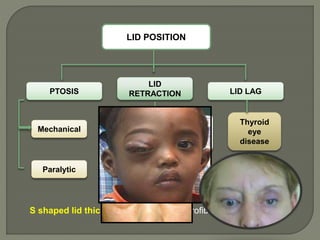 LID POSITION
PTOSIS
LID
RETRACTION LID LAG
Mechanical
Paralytic
Thyroid
eye
disease
Large
orbital
neoplasm
Thyroid
eye
disease
S shaped lid thickening - Plexiform neurofibroma
 