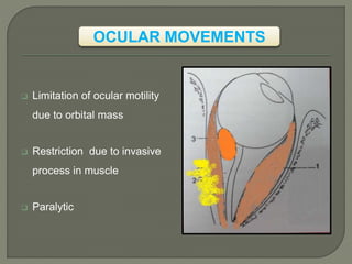 OCULAR MOVEMENTS
 Limitation of ocular motility
due to orbital mass
 Restriction due to invasive
process in muscle
 Paralytic
 