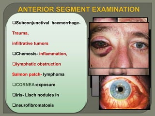 CONJUNCTIVA
Dilated vascular channel at the
canthus with chemosis-
dysthyroid disease
Epibulbar dark-red corkscrew
vessels – increased venous
pressure, AV malformation
Diffuse conjunctival congestion-
orbital inflammatory or infectious
disease
Sectoral congestion and
chemosis- Myositis
Subconjunctival haemorrhage-
Trauma,
infiltrative tumors
Chemosis- inflammation,
lymphatic obstruction
Salmon patch- lymphoma
CORNEA-exposure
Iris- Lisch nodules in
neurofibromatosis
 