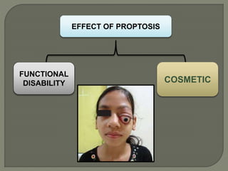 EFFECT OF PROPTOSIS
COSMETIC
FUNCTIONAL
DISABILITY
 