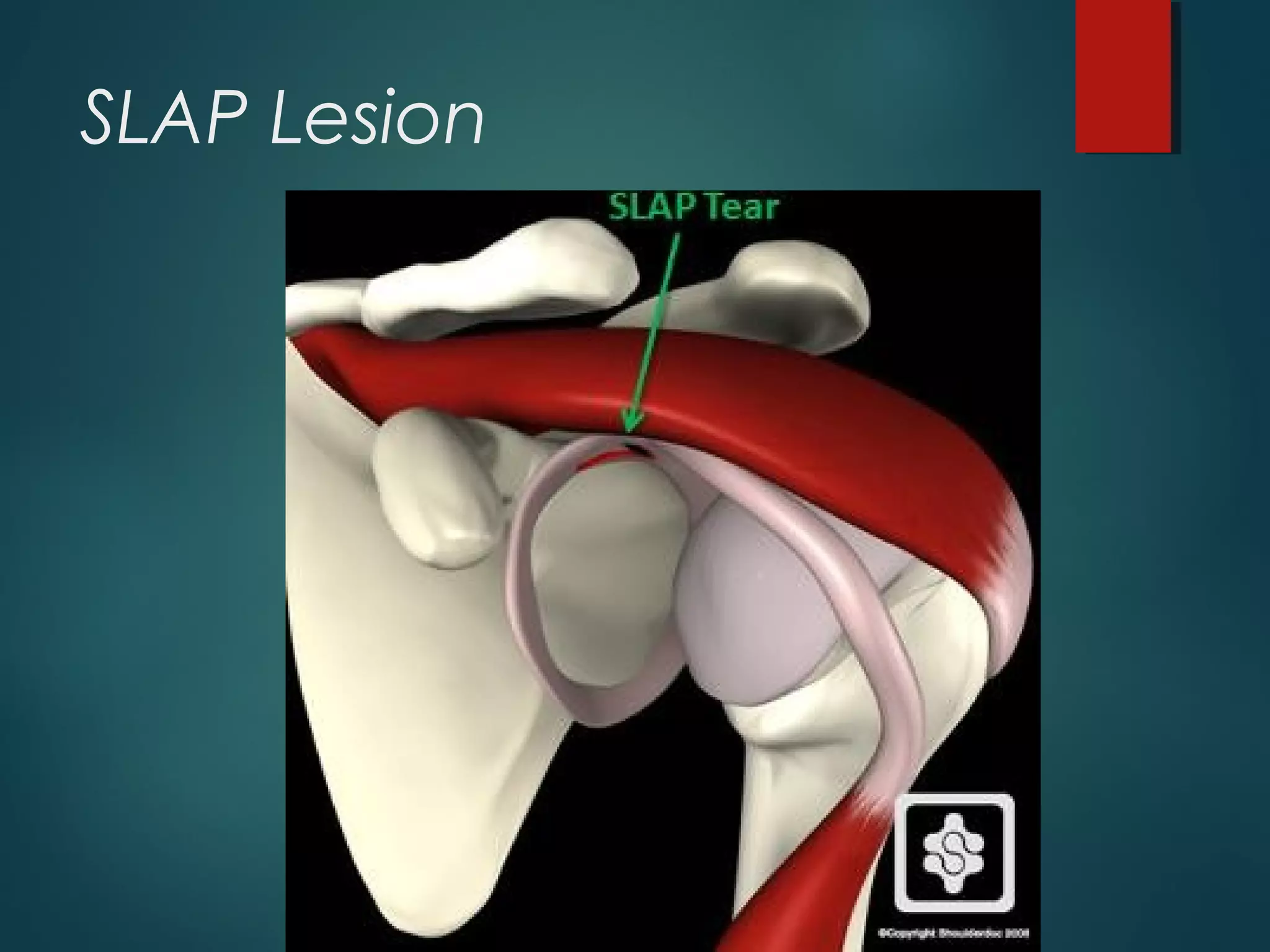 SLAP Lesion 
 