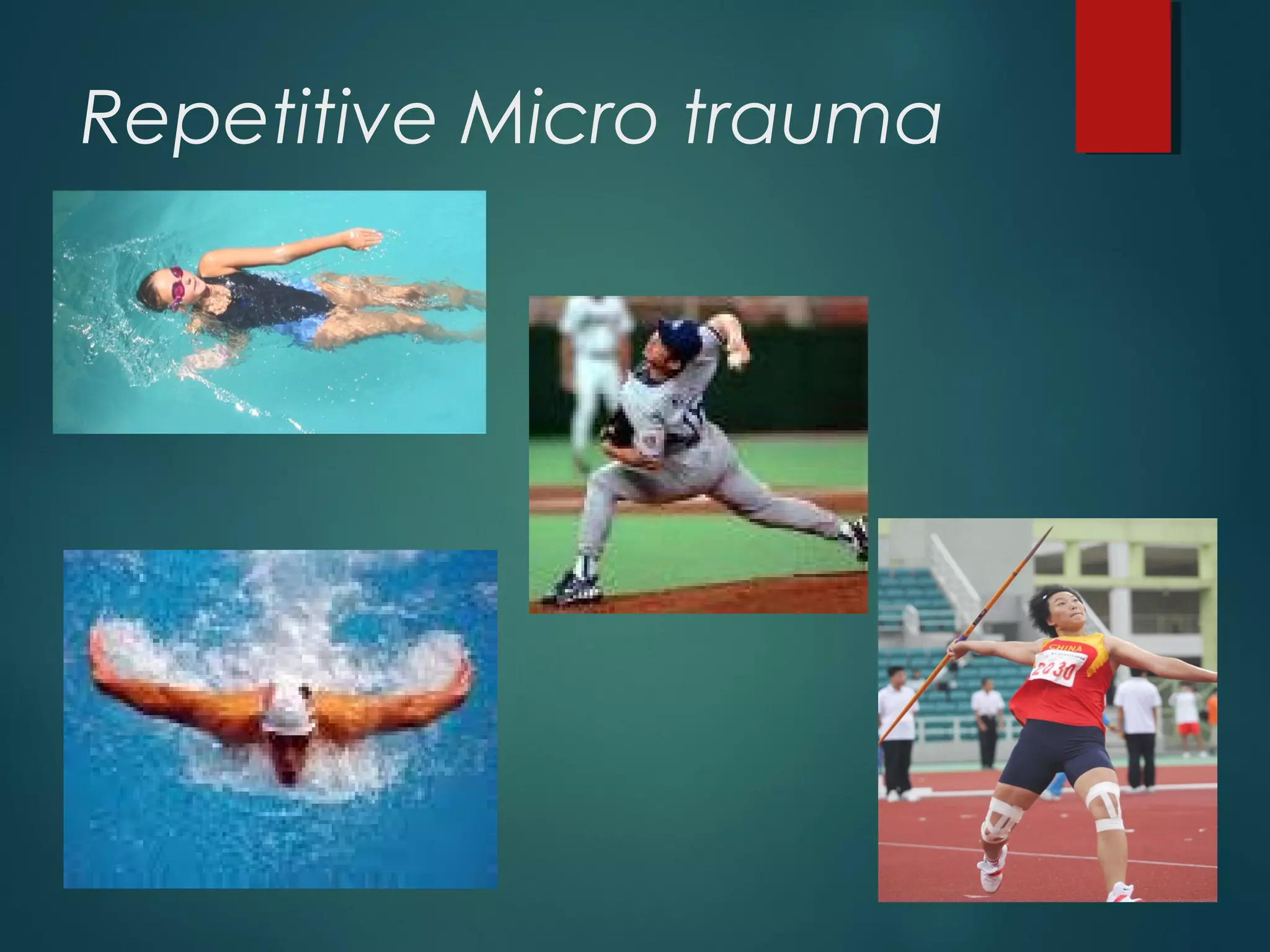 Repetitive Micro trauma 
 