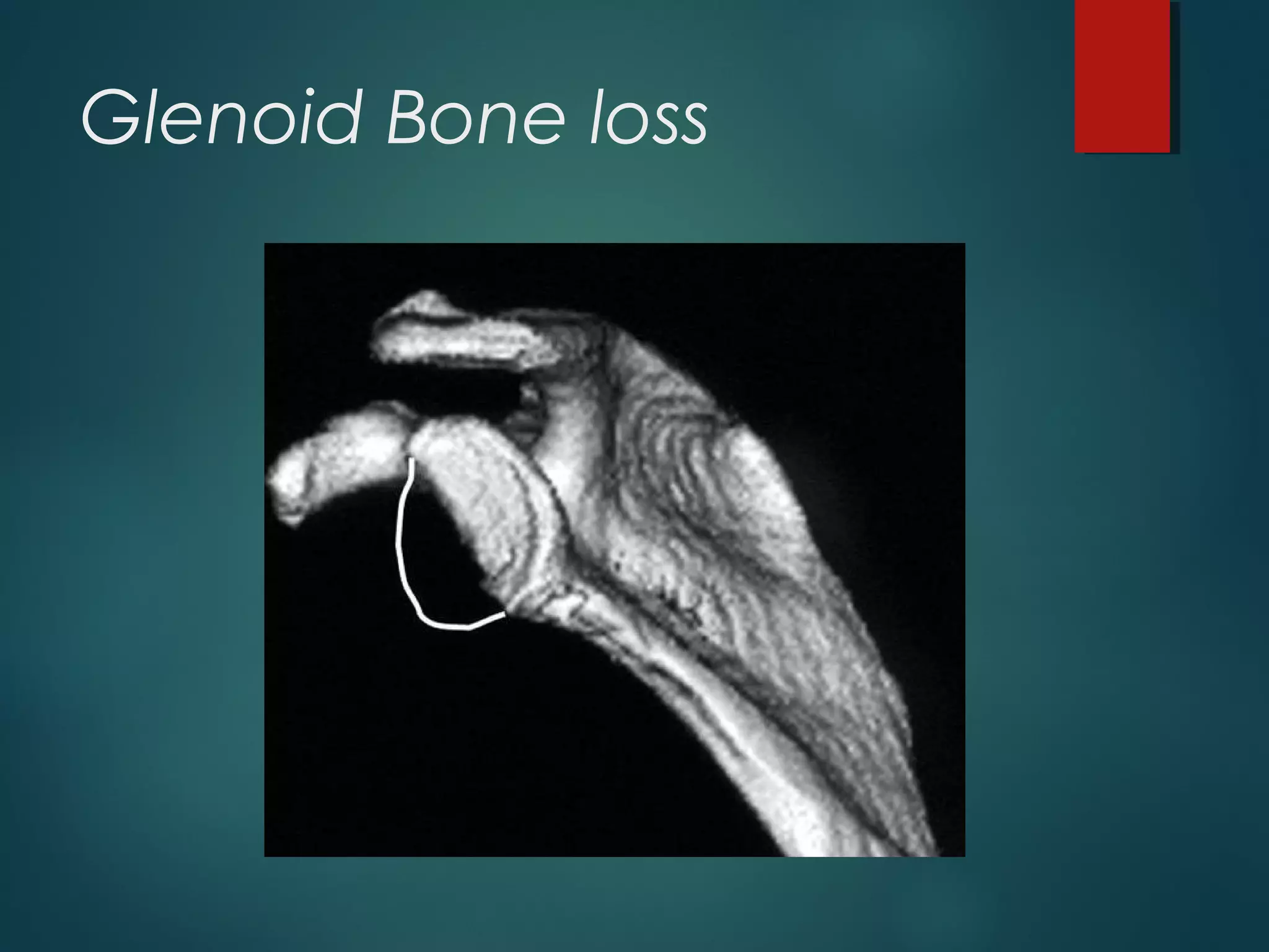 Glenoid Bone loss 
 