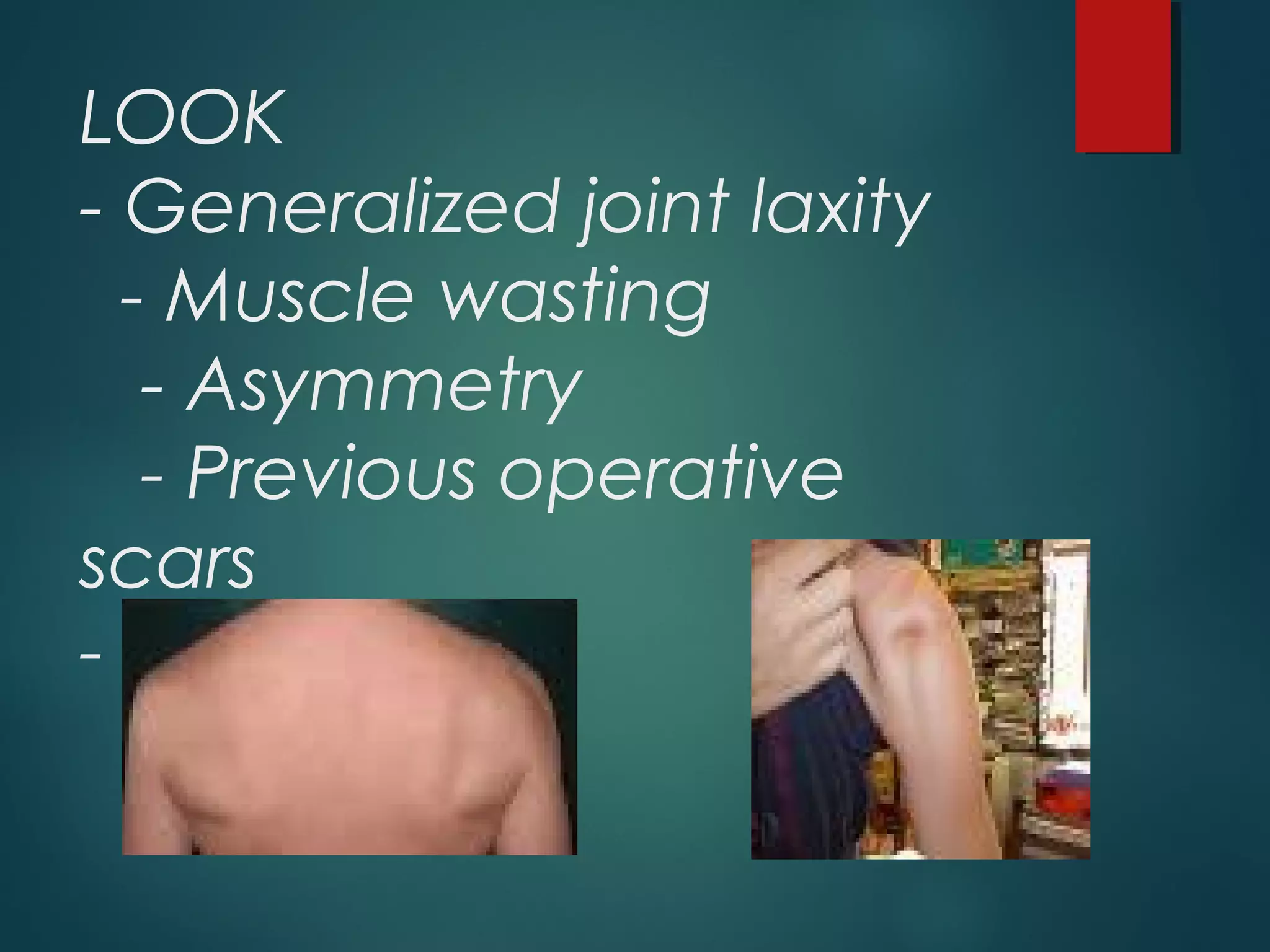 LOOK 
- Generalized joint laxity 
- Muscle wasting 
- Asymmetry 
- Previous operative 
scars 
- Ecchymosis 
 