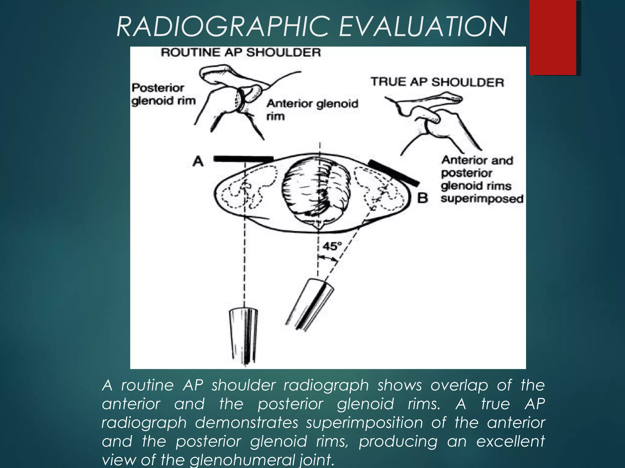 RADIOGRAPHIC EVALUATION 
A routine AP shoulder radiograph shows overlap of the 
anterior and the posterior glenoid rims. A true AP 
radiograph demonstrates superimposition of the anterior 
and the posterior glenoid rims, producing an excellent 
view of the glenohumeral joint. 
 