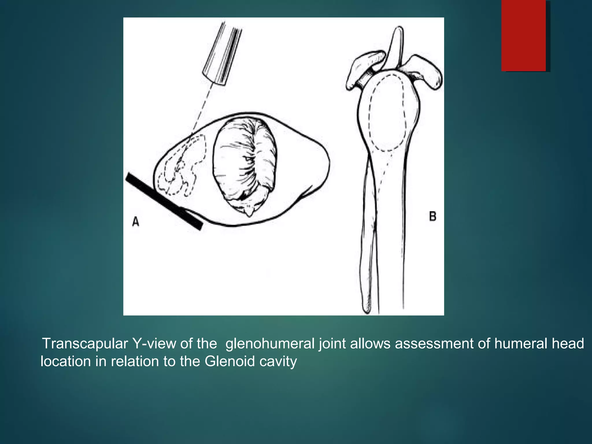 Transcapular Y-view of the glenohumeral joint allows assessment of humeral head 
location in relation to the Glenoid cavity 
 