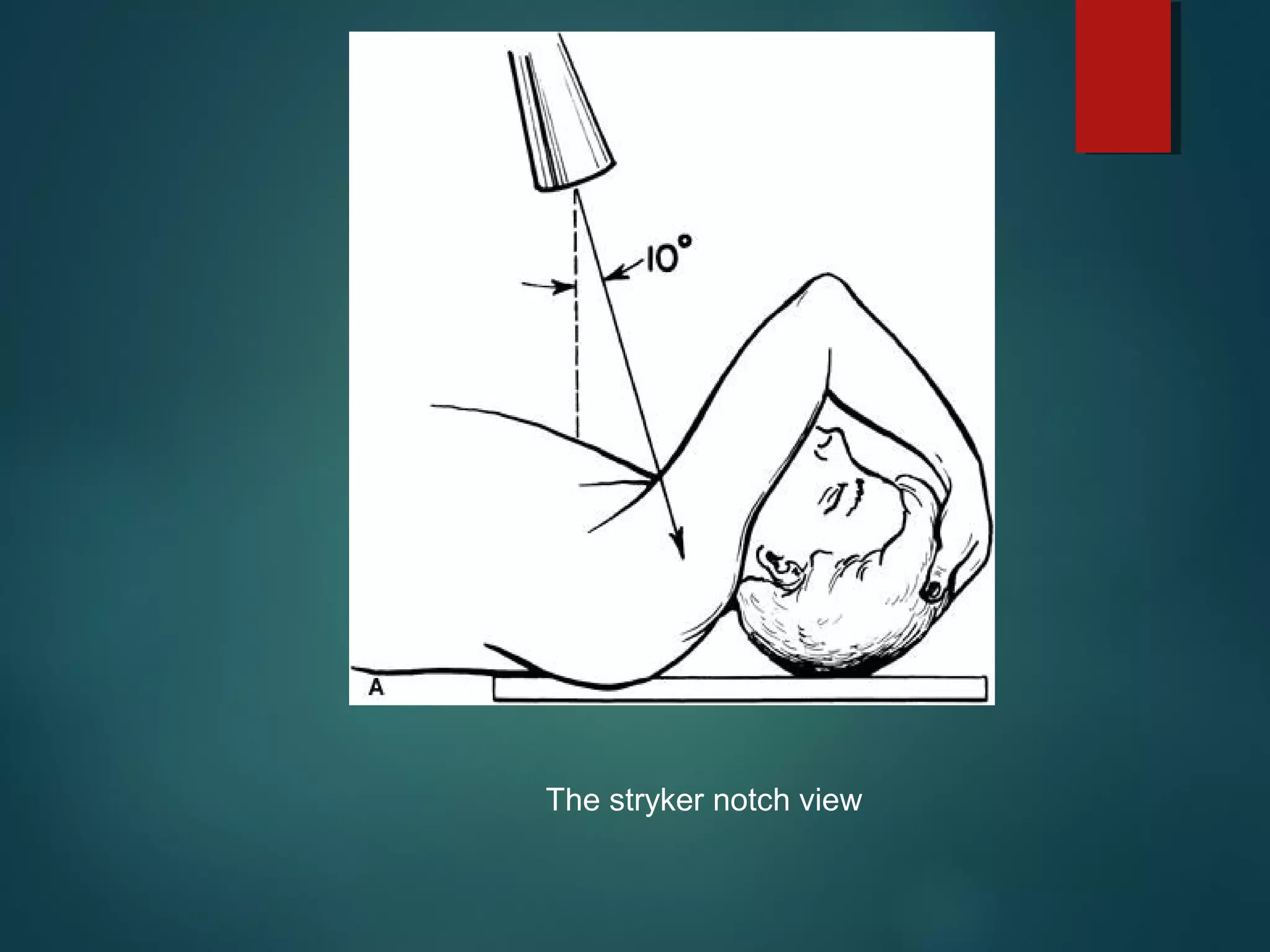 The stryker notch view 
 