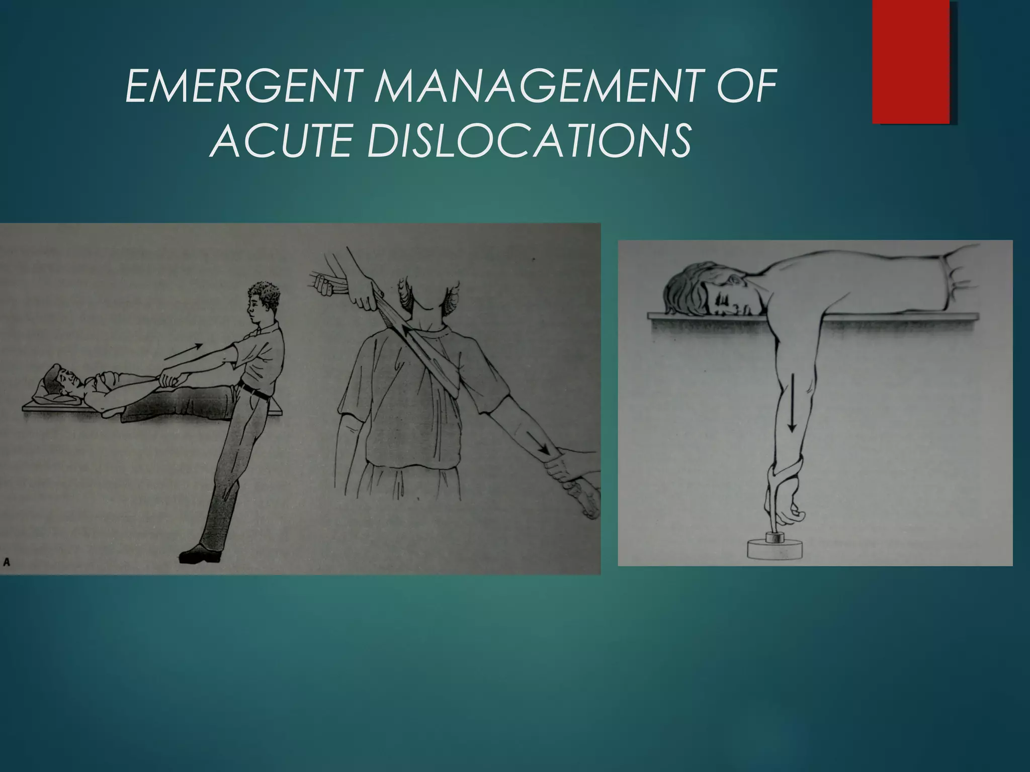 EMERGENT MANAGEMENT OF 
ACUTE DISLOCATIONS 
 