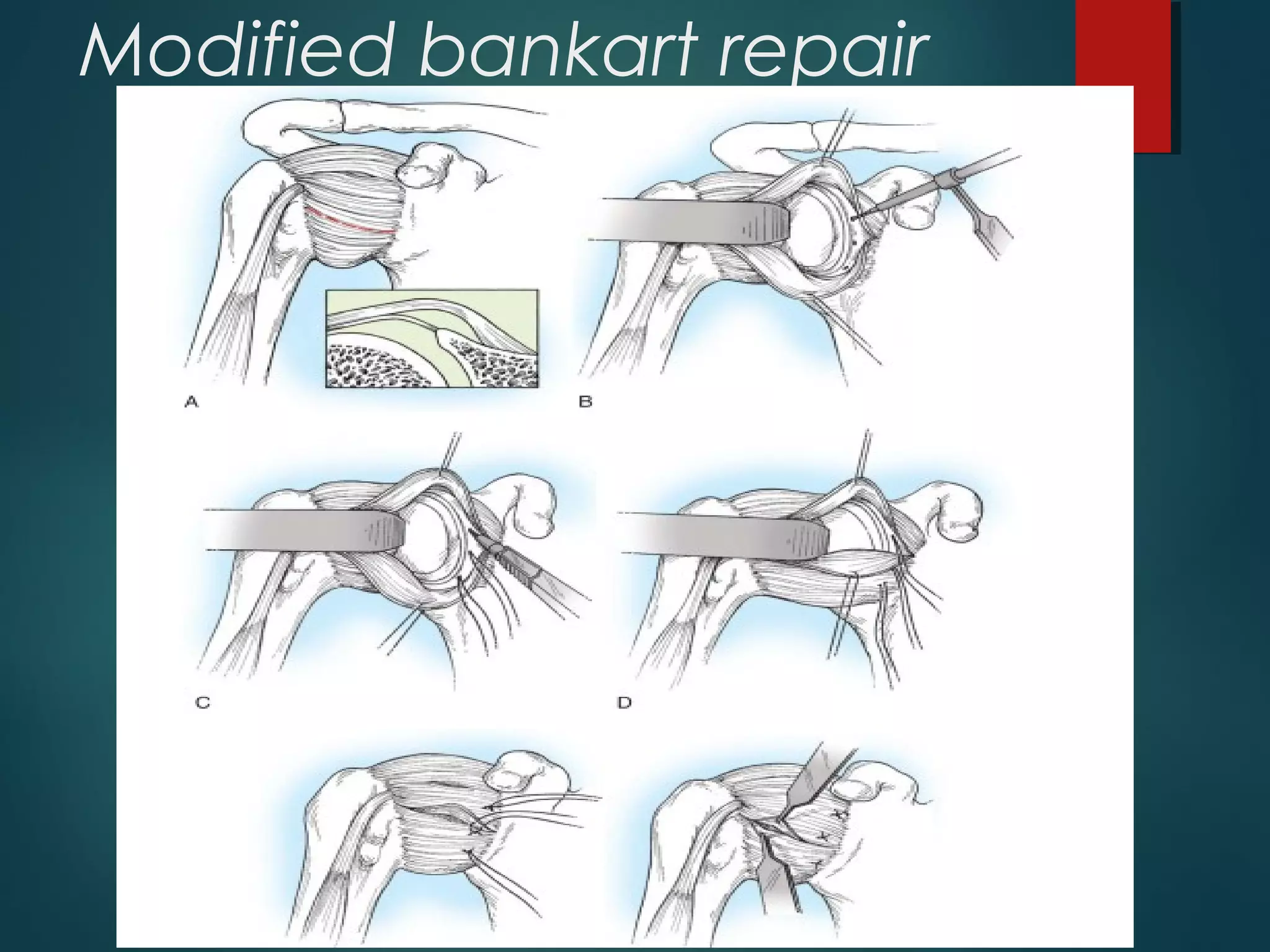 Modified bankart repair 
 