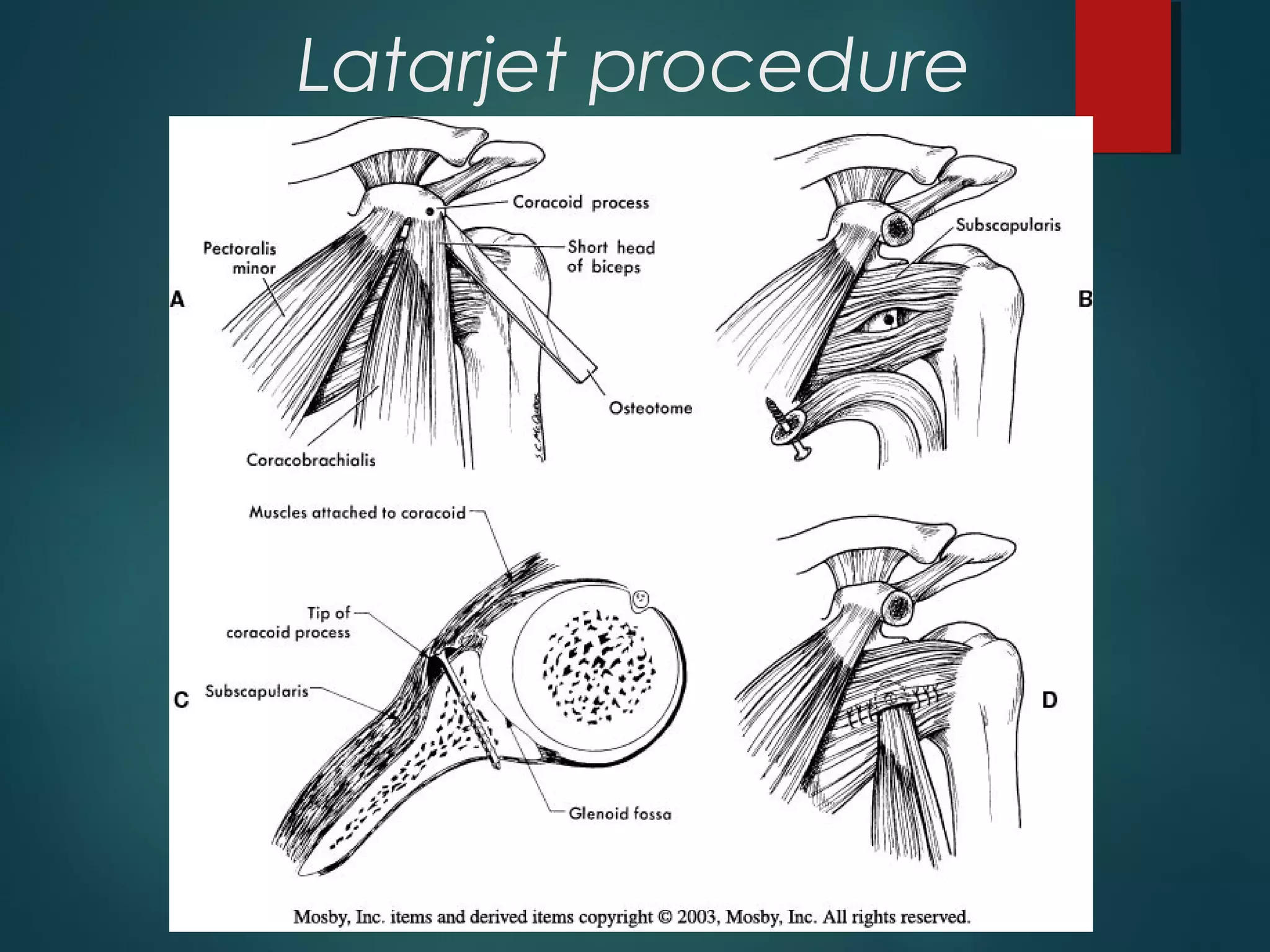 Latarjet procedure 
 