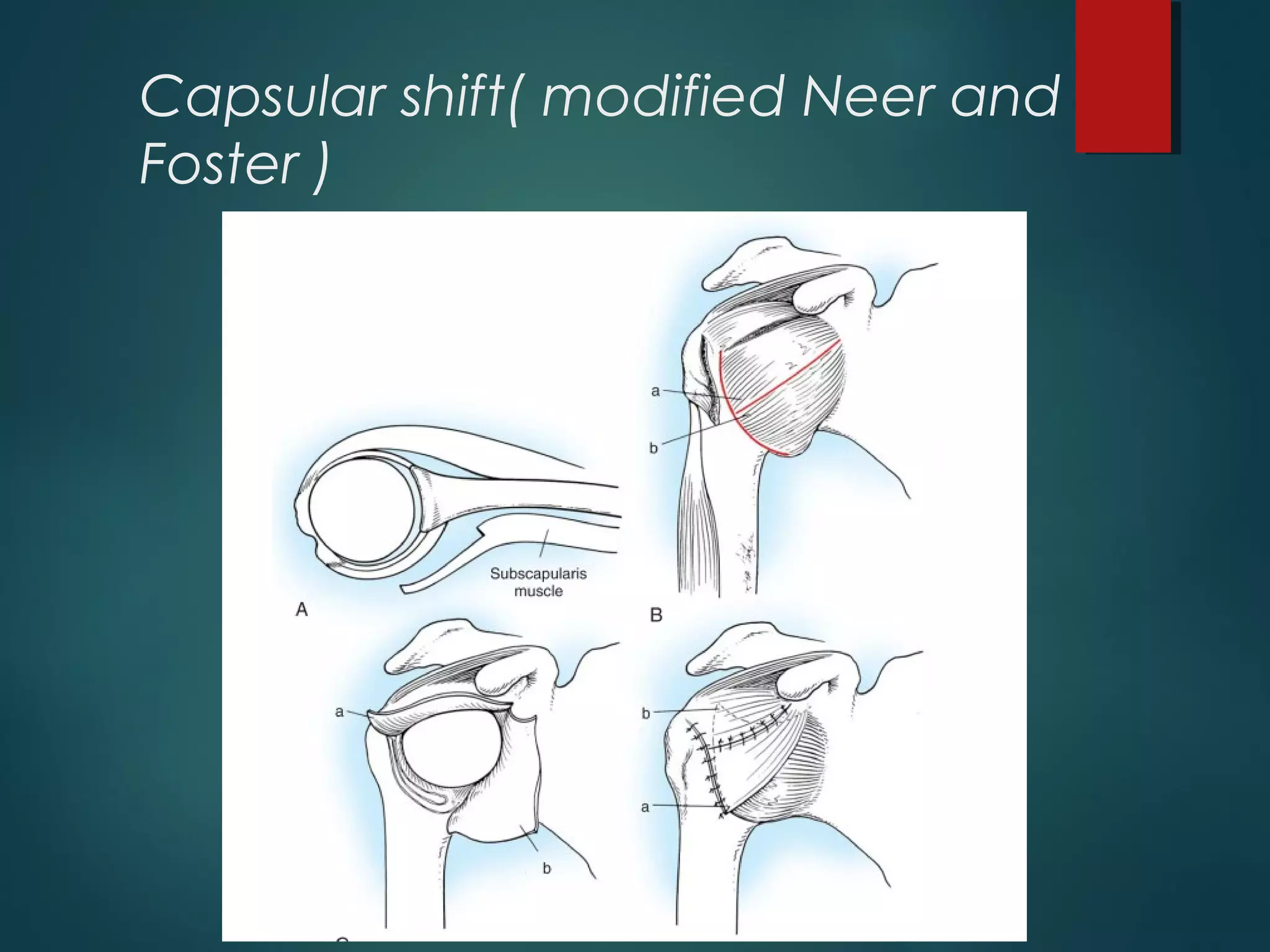 Capsular shift( modified Neer and 
Foster ) 
 