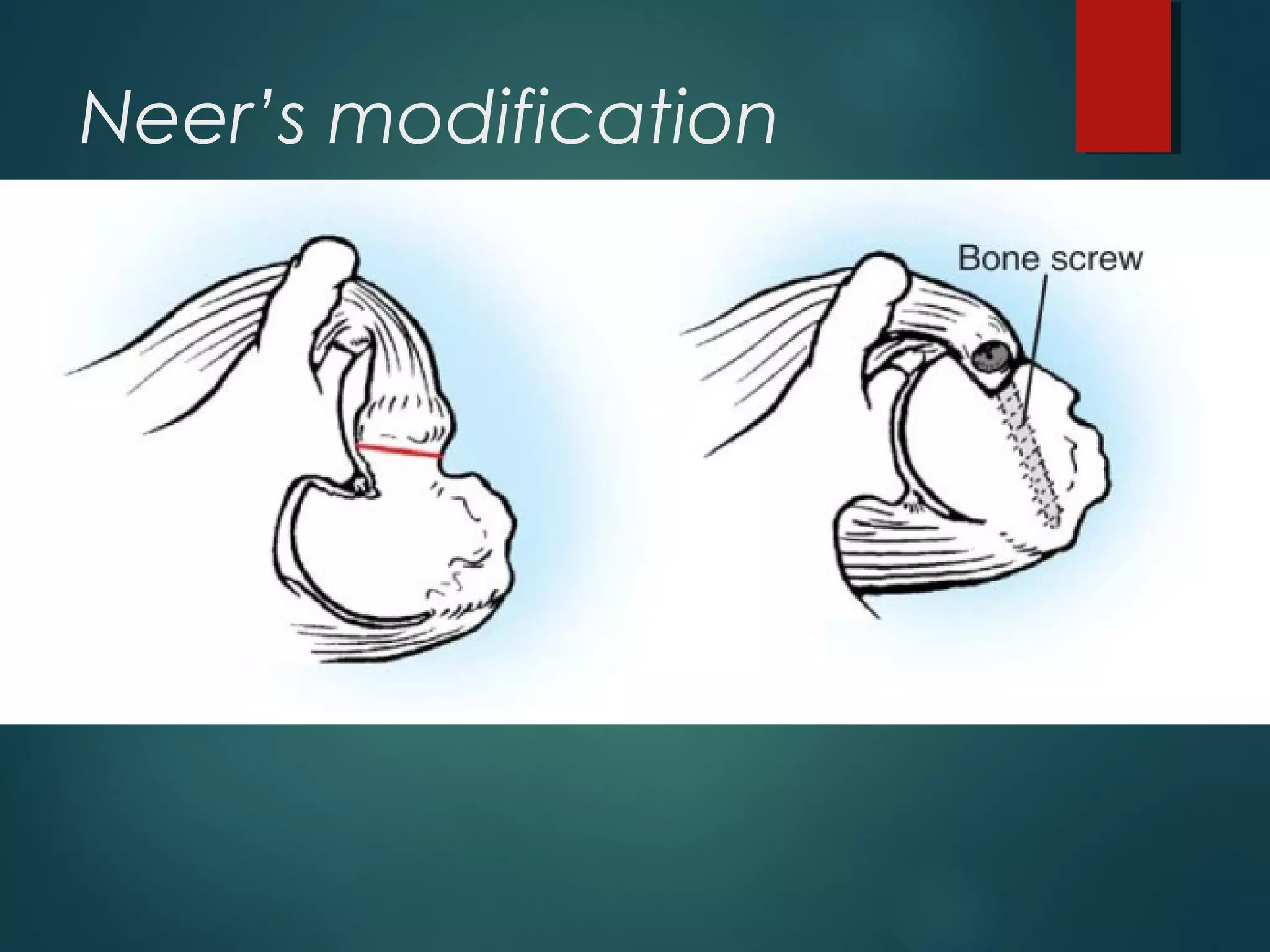 Neer’s modification 
 