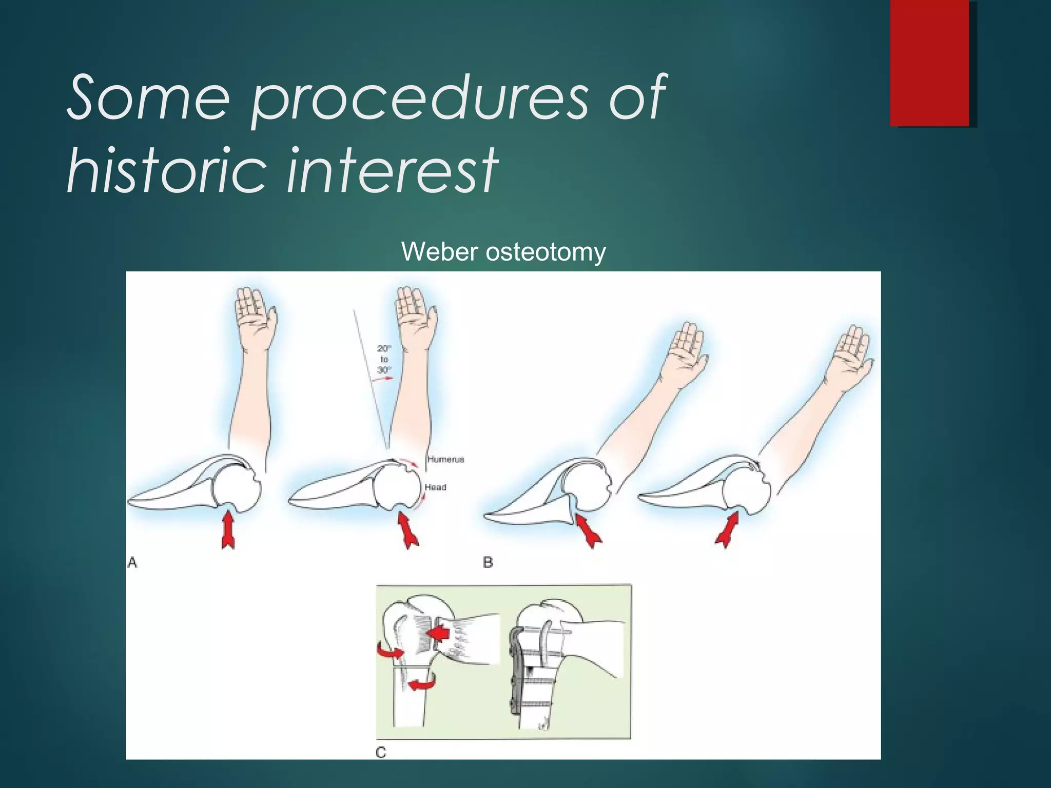 Some procedures of 
historic interest 
Weber osteotomy 
 