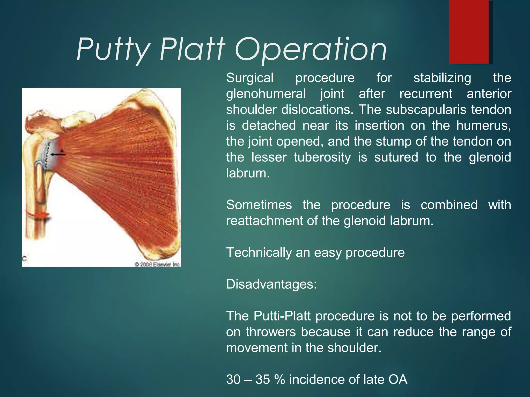 Putty Platt Operation 
Surgical procedure for stabilizing the 
glenohumeral joint after recurrent anterior 
shoulder dislocations. The subscapularis tendon 
is detached near its insertion on the humerus, 
the joint opened, and the stump of the tendon on 
the lesser tuberosity is sutured to the glenoid 
labrum. 
Sometimes the procedure is combined with 
reattachment of the glenoid labrum. 
Technically an easy procedure 
Disadvantages: 
The Putti-Platt procedure is not to be performed 
on throwers because it can reduce the range of 
movement in the shoulder. 
30 – 35 % incidence of late OA 
 