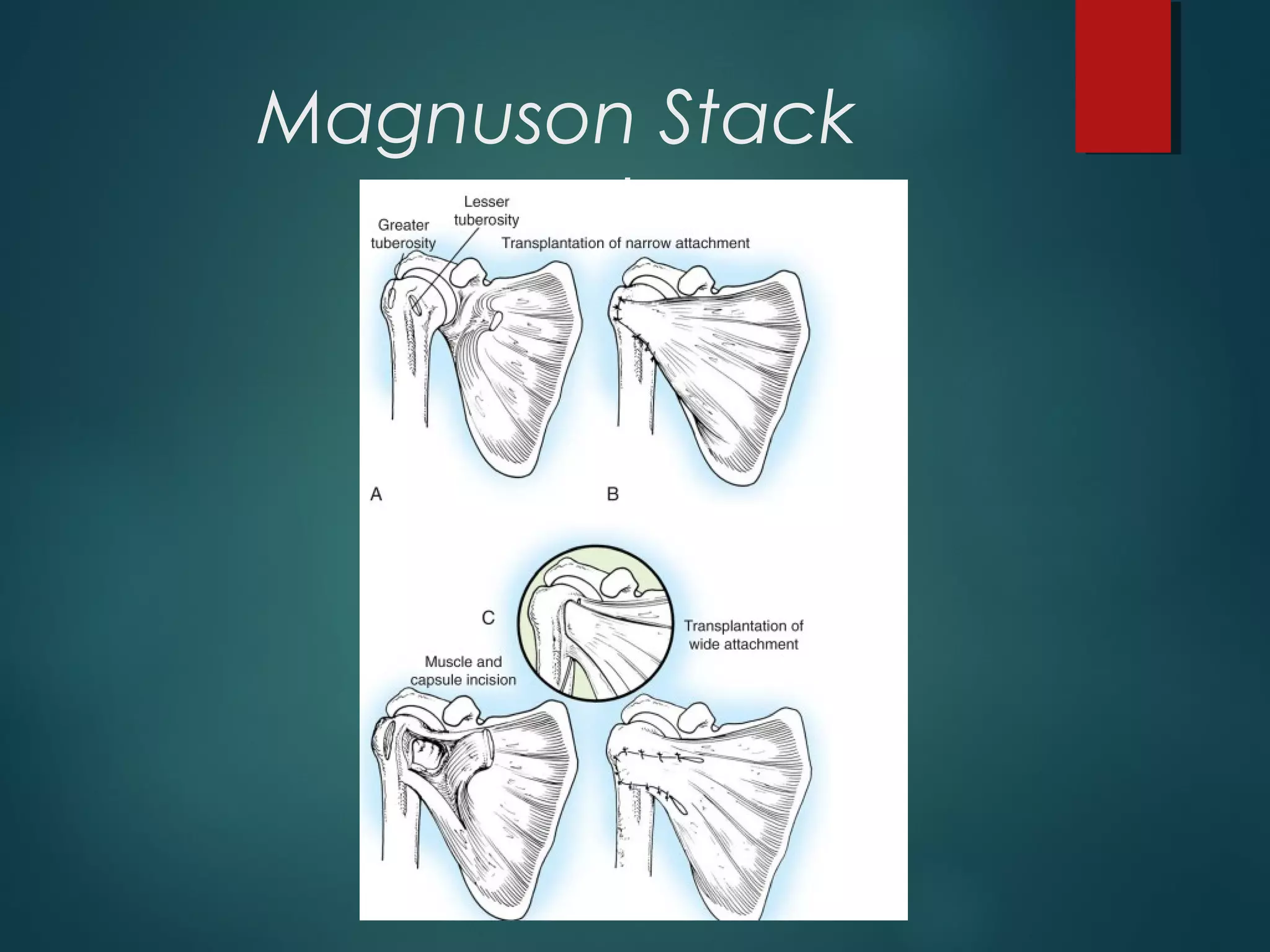Magnuson Stack 
procedure 
 