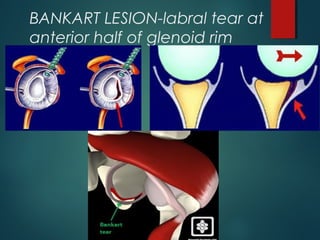 BANKART LESION-labral tear at 
anterior half of glenoid rim 
 