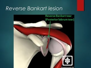 Reverse Bankart lesion 
 