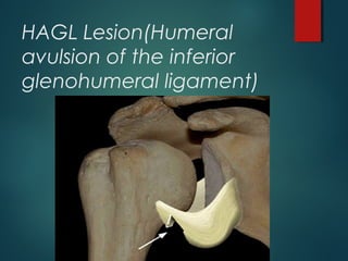 HAGL Lesion(Humeral 
avulsion of the inferior 
glenohumeral ligament) 
 