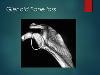 Glenoid Bone loss 
 