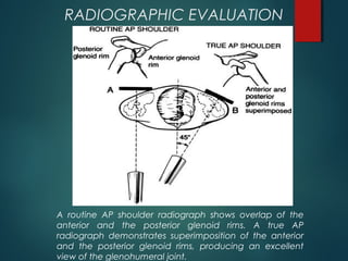 RADIOGRAPHIC EVALUATION 
A routine AP shoulder radiograph shows overlap of the 
anterior and the posterior glenoid rims. A true AP 
radiograph demonstrates superimposition of the anterior 
and the posterior glenoid rims, producing an excellent 
view of the glenohumeral joint. 
 